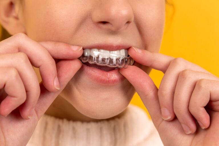 Photo Invisalign